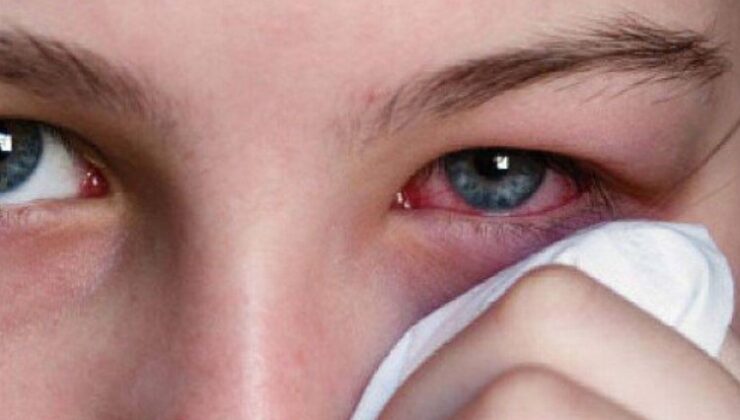 Göz yüzeyinde temizlenmeyen maddeler enfeksiyonu arttırıyor