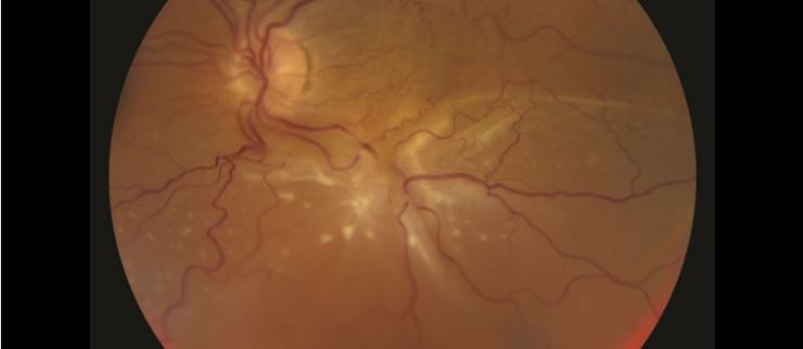 Retina Yırtılması Nasıl Anlaşılır?