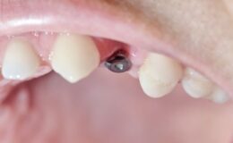 İmplant Diş Nedir ve Nasıl Yapılır?